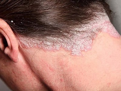 Bệnh vảy nến da đầu và cách điều trị an toàn từ thảo dược